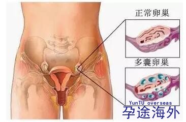 昆凌自曝有多囊问题?多囊性卵巢症候群是怎么回事?可以去泰国做试管吗?